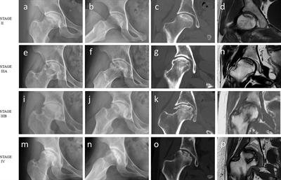 Less sclerotic microarchitecture pattern with increased bone resorption in glucocorticoid-associated osteonecrosis of femoral head as compared to alcohol-associated osteonecrosis of femoral head